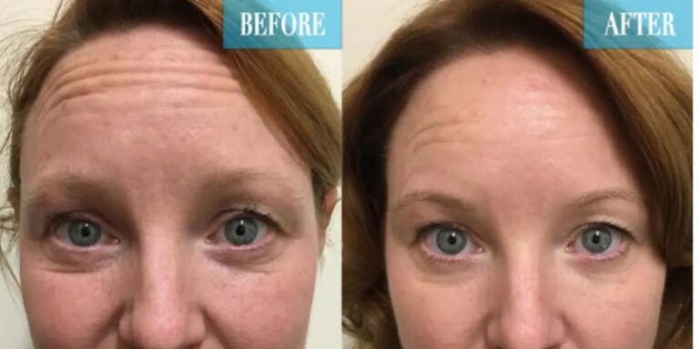 Scarlet rf microneedling